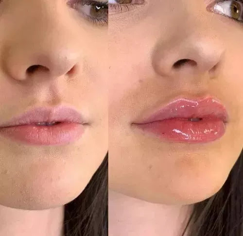 Maximizador de labios